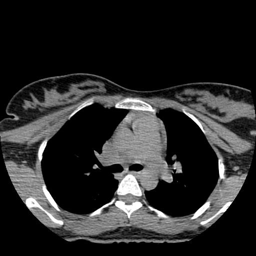 File:Choriocarcinoma of ovary with cerebral and pulmonary metastases (Radiopaedia 25983-26119 Axial non-contrast 120).jpg
