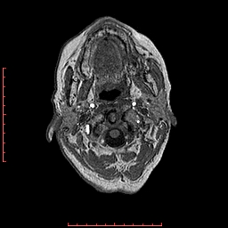 Choroid plexus xanthogranuloma (Radiopaedia 67843-77270 Axial T1 158).jpg
