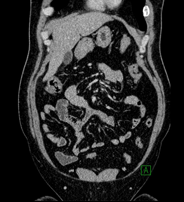 Chromophobe renal cell carcinoma (Radiopaedia 84286-99573 H 49).jpg
