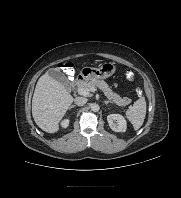 Chromophobe renal cell carcinoma (Radiopaedia 84337-99644 C 44).jpg