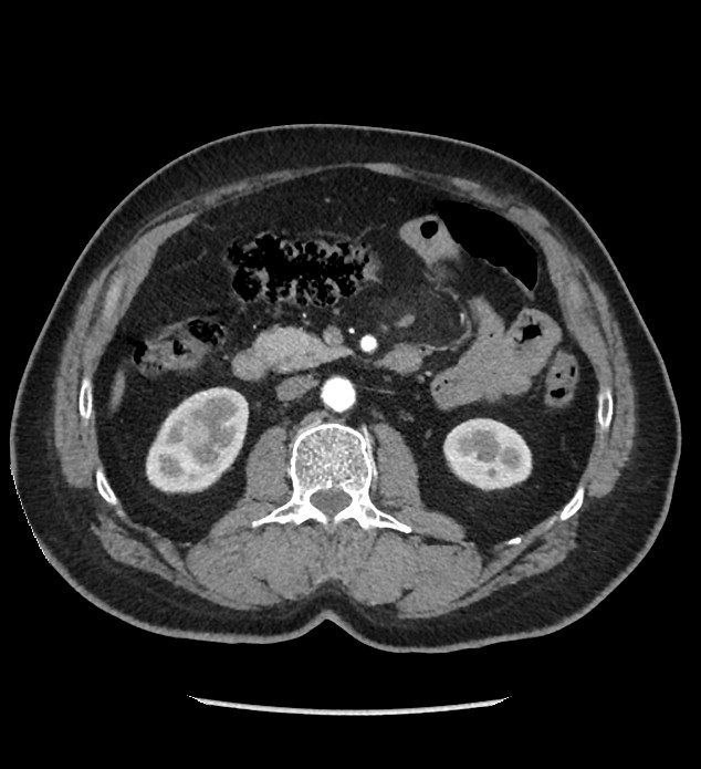Chromophobe renal cell carcinoma (Radiopaedia 86879-103083 B 64).jpg