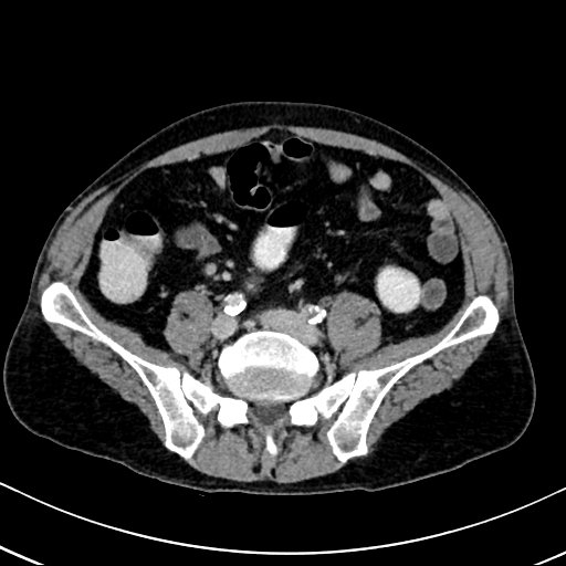 Chronic appendicitis complicated by appendicular abscess, pylephlebitis and liver abscess (Radiopaedia 54483-60700 B 103).jpg