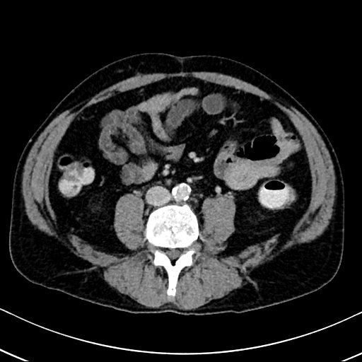 Chronic appendicitis complicated by appendicular abscess, pylephlebitis and liver abscess (Radiopaedia 54483-60700 B 90).jpg