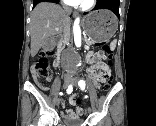 File:Chronic contained rupture of abdominal aortic aneurysm with extensive erosion of the vertebral bodies (Radiopaedia 55450-61901 D 35).jpg