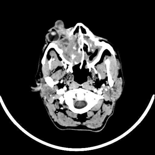 Chronic invasive fungal sinusitis with intraorbital and intracranial extension (Radiopaedia 56387-63046 B 48).jpg