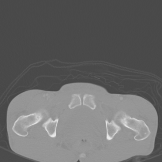 Chronic large bowel pseudo-obstruction (Radiopaedia 43181-46492 Axial bone window 161).jpg