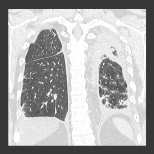 Chronic lung allograft dysfunction - restrictive form (Radiopaedia 60595-68316 Coronal lung window 74).jpg