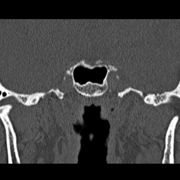 Chronic maxillary sinusitis (Radiopaedia 27879-28116 Coronal bone window 55).jpg