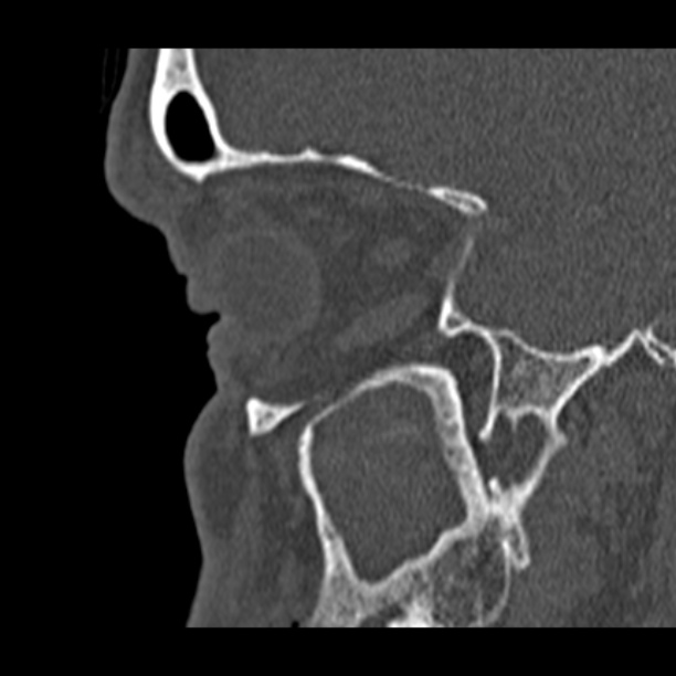 Chronic maxillary sinusitis (Radiopaedia 27879-28116 Sagittal bone window 11).jpg