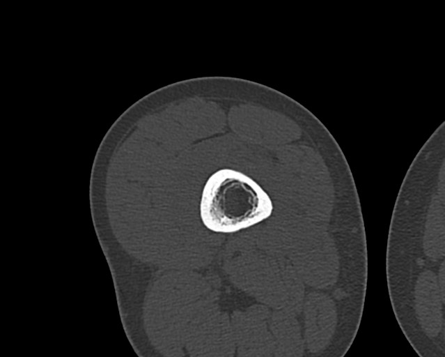 File:Chronic ostemyelitis of the femur with long sinus tract (Radiopaedia 74947-85982 Axial bone window 118).jpg