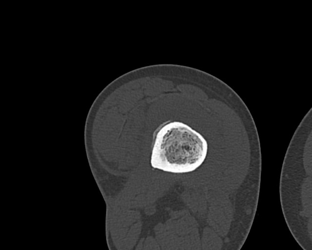 Chronic ostemyelitis of the femur with long sinus tract (Radiopaedia 74947-85982 Axial bone window 146).jpg