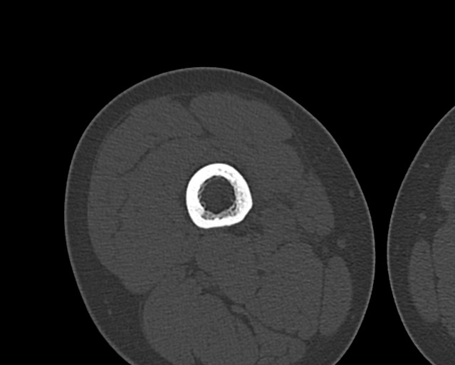 Chronic ostemyelitis of the femur with long sinus tract (Radiopaedia 74947-85982 Axial bone window 94).jpg