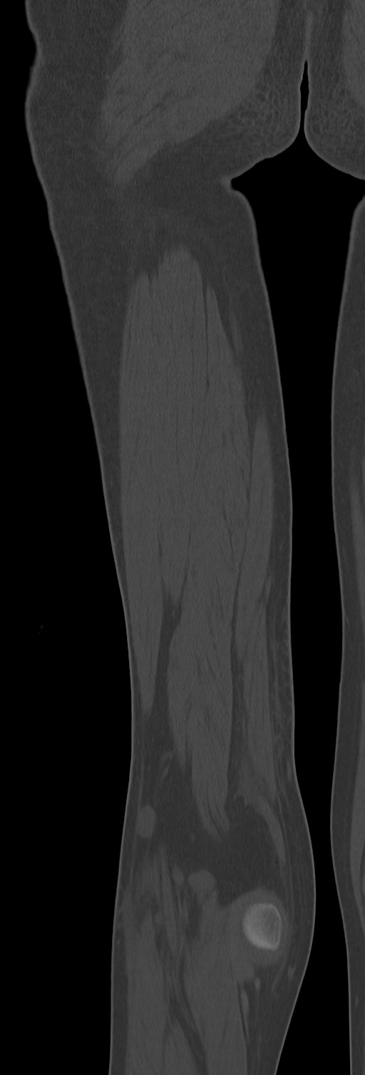 Chronic ostemyelitis of the femur with long sinus tract (Radiopaedia 74947-85982 Coronal bone window 66).jpg