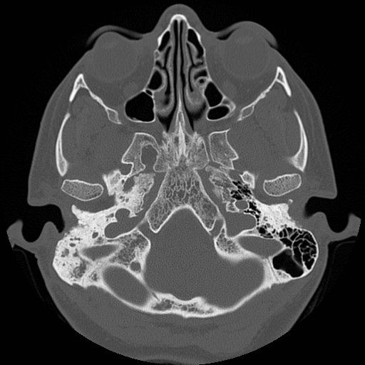 File:Chronic otomastoiditis (Radiopaedia 27138-27309 Axial bone window 15).jpg