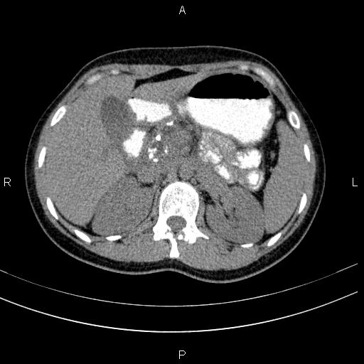 Chronic pancreatitis (Radiopaedia 64576-73450 Axial non-contrast 46).jpg