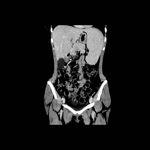 Chronic portal venous thrombosis with cavernous transformation (Radiopaedia 73618-84398 B 53).jpg
