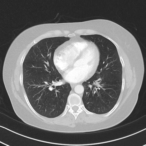 Chronic pulmonary embolus (Radiopaedia 39129-41341 Axial lung window 39).png