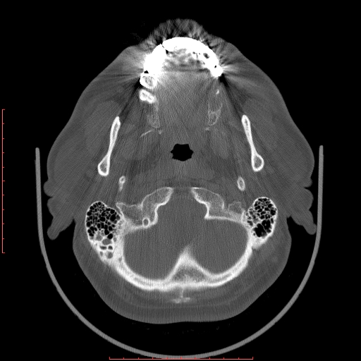 Chronic submandibular sialolithiasis (Radiopaedia 69817-79814 Axial bone window 10).jpg