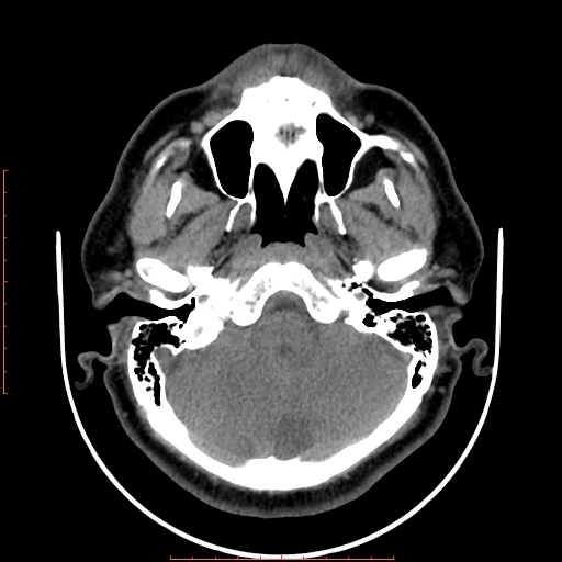 Chronic submandibular sialolithiasis (Radiopaedia 69817-79814 Axial non-contrast 15).jpg