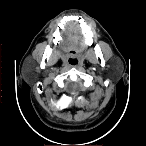 Chronic submandibular sialolithiasis (Radiopaedia 69817-79814 Axial non-contrast 58).jpg