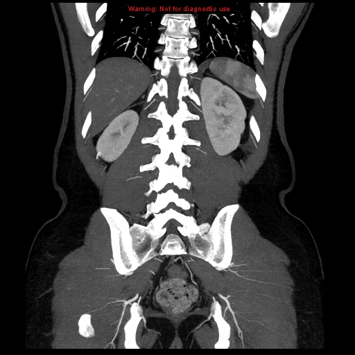 File:Circumaortic left renal vein (Radiopaedia 9069-9792 B 35).jpg