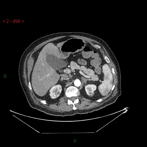 Circumaortic left renal vein and doubled left renal arteries (Radiopaedia 52268-58158 A 26).jpg