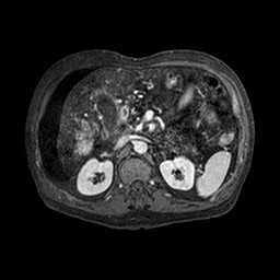 Cirrhosis and hepatocellular carcinoma in the setting of hemochromatosis (Radiopaedia 75394-86594 Axial T1 C+ fat sat 203).jpg