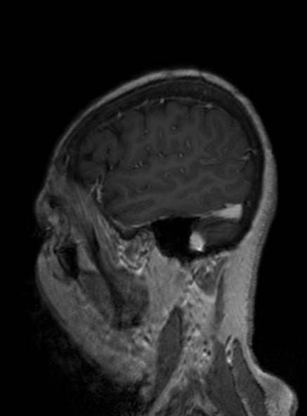 Clival meningioma (Radiopaedia 53278-59248 Sagittal T1 C+ 163).jpg