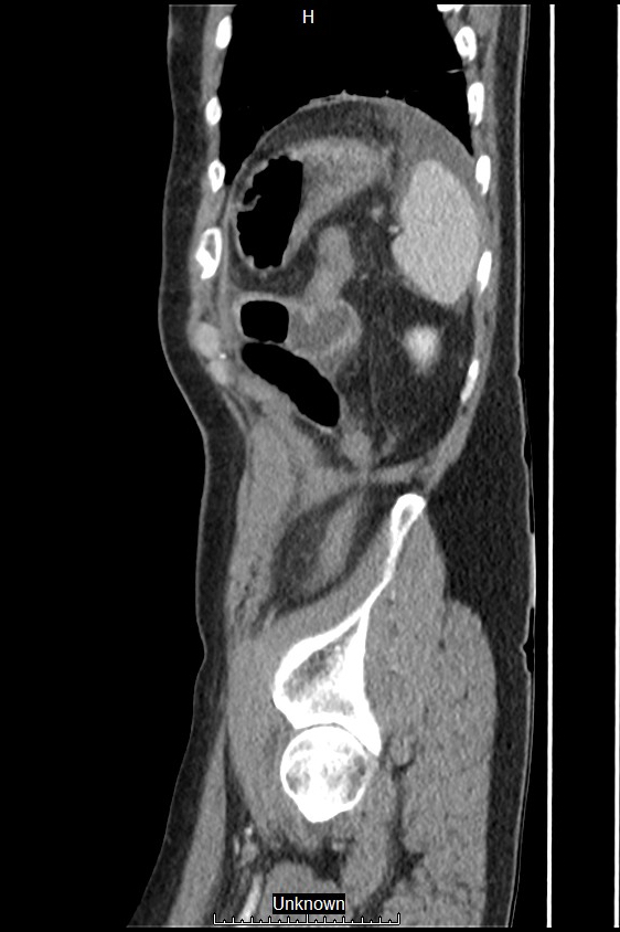 Closed loop bowel obstruction and ischemia (Radiopaedia 86959-103180 C 6).jpg