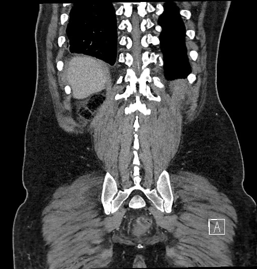 Closed loop obstruction - internal hernia into nephrectomy bed (Radiopaedia 59867-67320 B 120).jpg