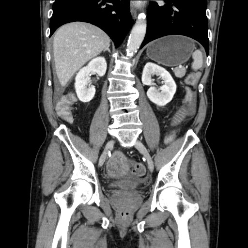 Closed loop obstruction due to adhesive band, resulting in small bowel ischemia and resection (Radiopaedia 83835-99023 E 80).jpg