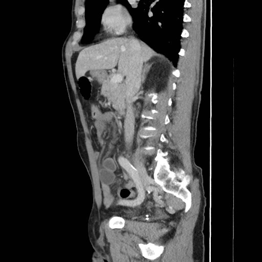 File:Closed loop small bowel obstruction (Radiopaedia 59227-66554 C 27).jpg