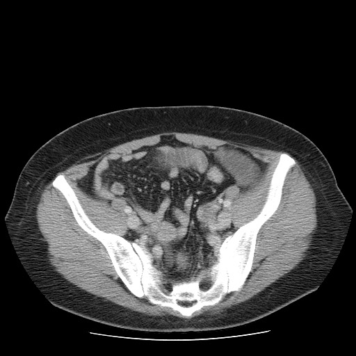 File:Closed loop small bowel obstruction (Radiopaedia 65403-74451 A 63).jpg