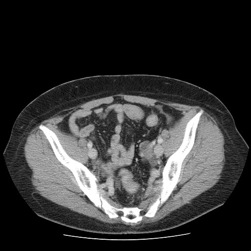 File:Closed loop small bowel obstruction (Radiopaedia 65403-74451 Axial 36).jpg