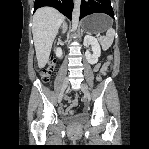 File:Closed loop small bowel obstruction (Radiopaedia 65403-74451 B 65).jpg