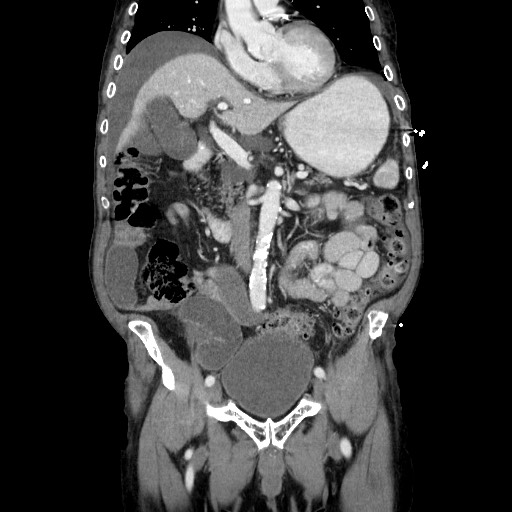 Closed loop small bowel obstruction - adhesive disease and hemorrhagic ischemia (Radiopaedia 86831-102990 B 59).jpg