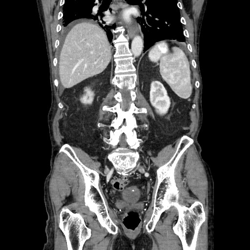 Closed loop small bowel obstruction - adhesive disease and hemorrhagic ischemia (Radiopaedia 86831-102990 B 89).jpg