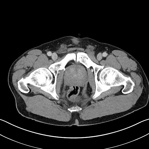 Closed loop small bowel obstruction - internal hernia (Radiopaedia 57806-64778 B 124).jpg
