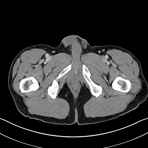 Closed loop small bowel obstruction - internal hernia (Radiopaedia 57806-64778 B 138).jpg