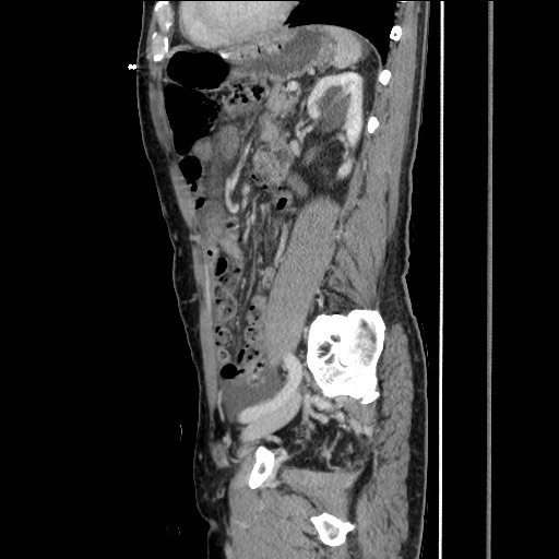 Closed loop small bowel obstruction - omental adhesion causing "internal hernia" (Radiopaedia 85129-100682 C 119).jpg