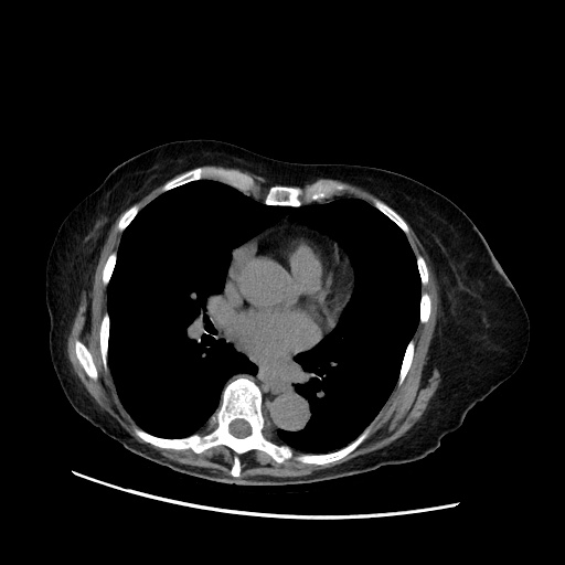 Closed loop small bowel obstruction due to adhesive band, with intramural hemorrhage and ischemia (Radiopaedia 83831-99017 Axial non-contrast 3).jpg