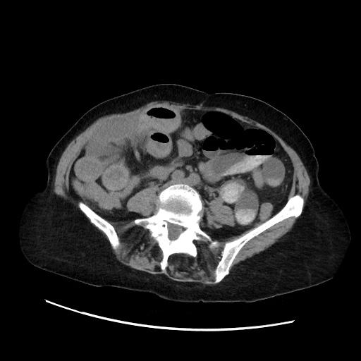 Closed loop small bowel obstruction due to adhesive band, with intramural hemorrhage and ischemia (Radiopaedia 83831-99017 Axial non-contrast 97).jpg