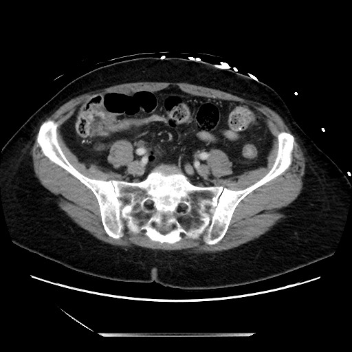 Closed loop small bowel obstruction due to adhesive bands - early and late images (Radiopaedia 83830-99014 A 109).jpg