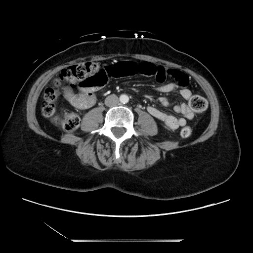 File:Closed loop small bowel obstruction due to adhesive bands - early and late images (Radiopaedia 83830-99014 A 81).jpg