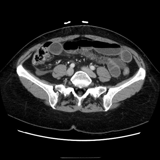 Closed loop small bowel obstruction due to adhesive bands - early and late images (Radiopaedia 83830-99015 A 113).jpg