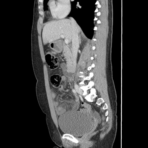 Closed loop small bowel obstruction due to trans-omental herniation (Radiopaedia 35593-37109 C 29).jpg
