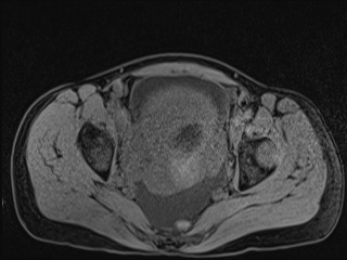 Closed loop small bowel obstruction in pregnancy (MRI) (Radiopaedia 87637-104031 F 56).jpg