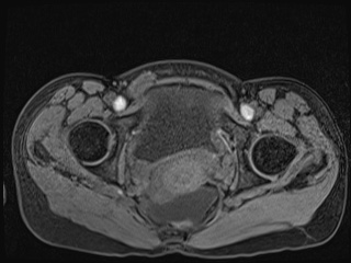 Closed loop small bowel obstruction in pregnancy (MRI) (Radiopaedia 87637-104031 F 66).jpg