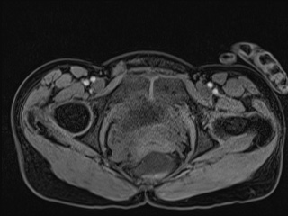 Closed loop small bowel obstruction in pregnancy (MRI) (Radiopaedia 87637-104031 G 23).jpg