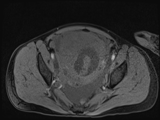 Closed loop small bowel obstruction in pregnancy (MRI) (Radiopaedia 87637-104031 G 5).jpg